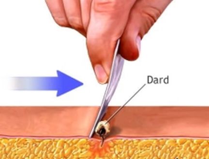 Faire glisser le tranchant de la lame parallèlement à la surface de la peau